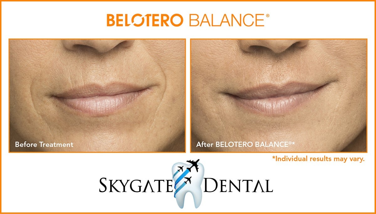 BELOTERO Skygate Dental
