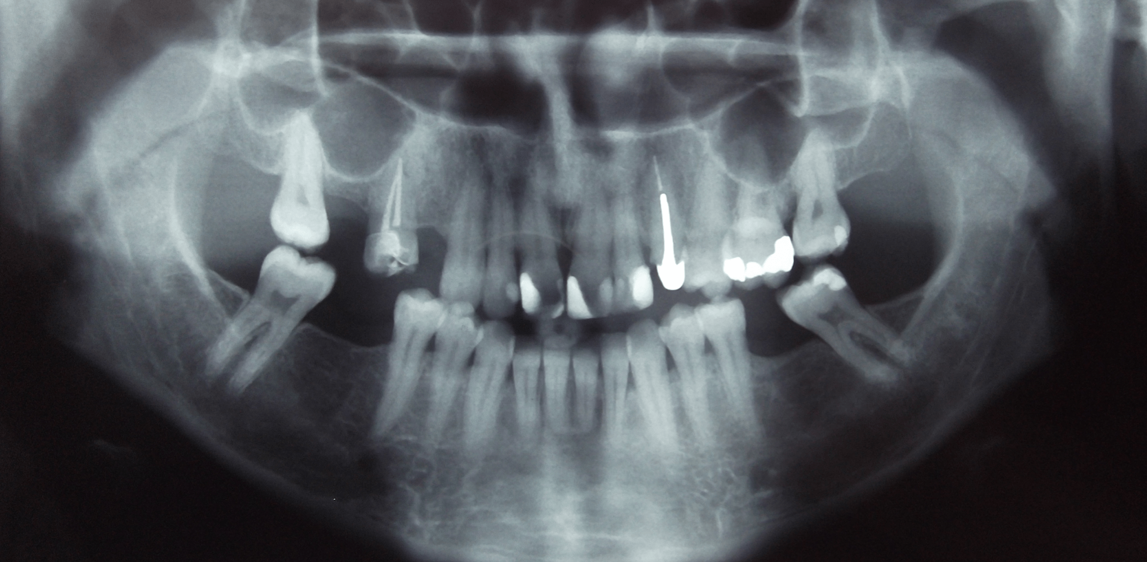 Dental Radiographs Skygate Dental 6940