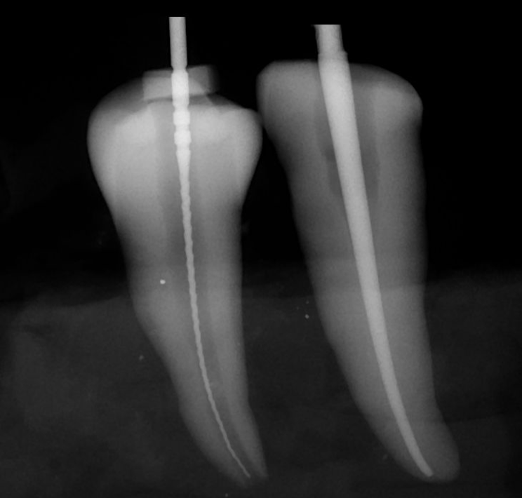 Skygate Dental Root Canal Filling
