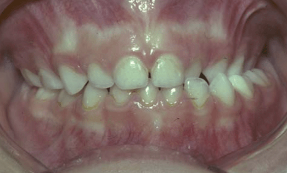 Orthodontics: Cross-Bite