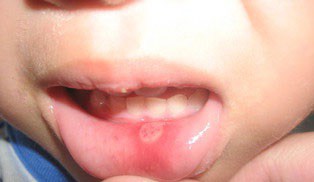 Skygate Dental Mouth Ulceration