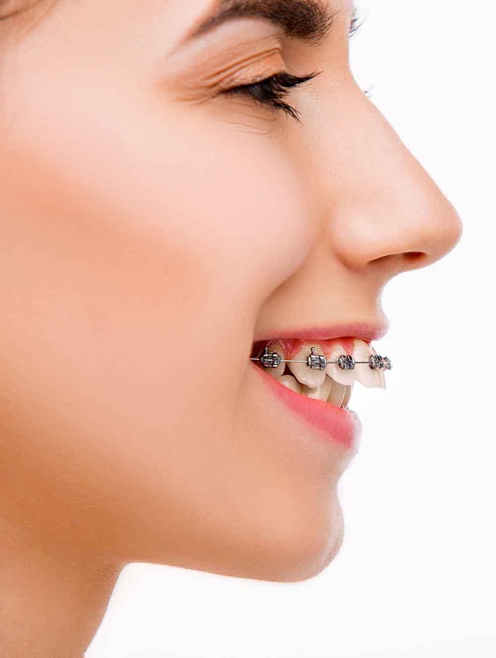 beautiful young woman with teeth braces