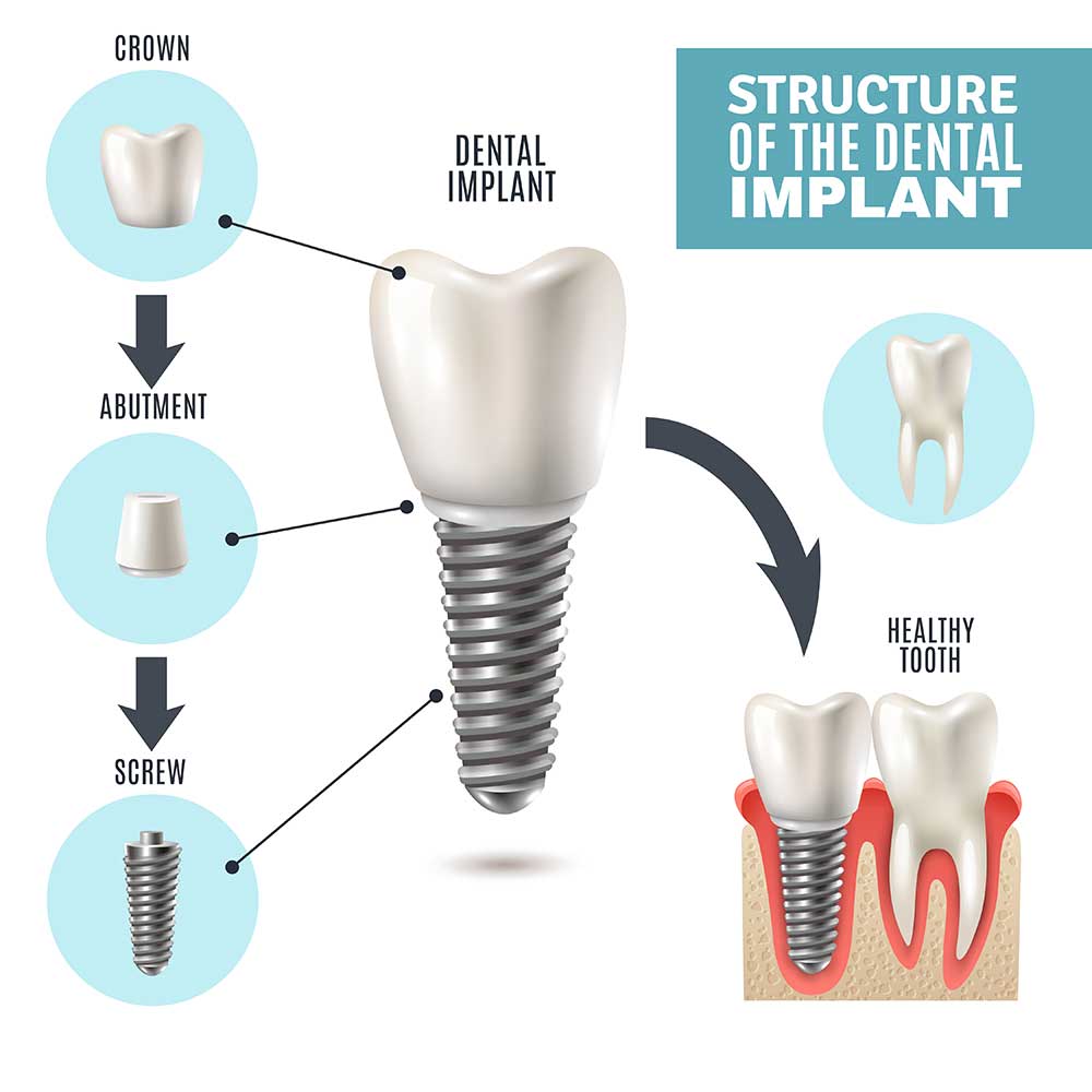 implant stages