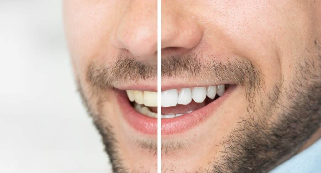 Close-up of man’s smile before and after whitening