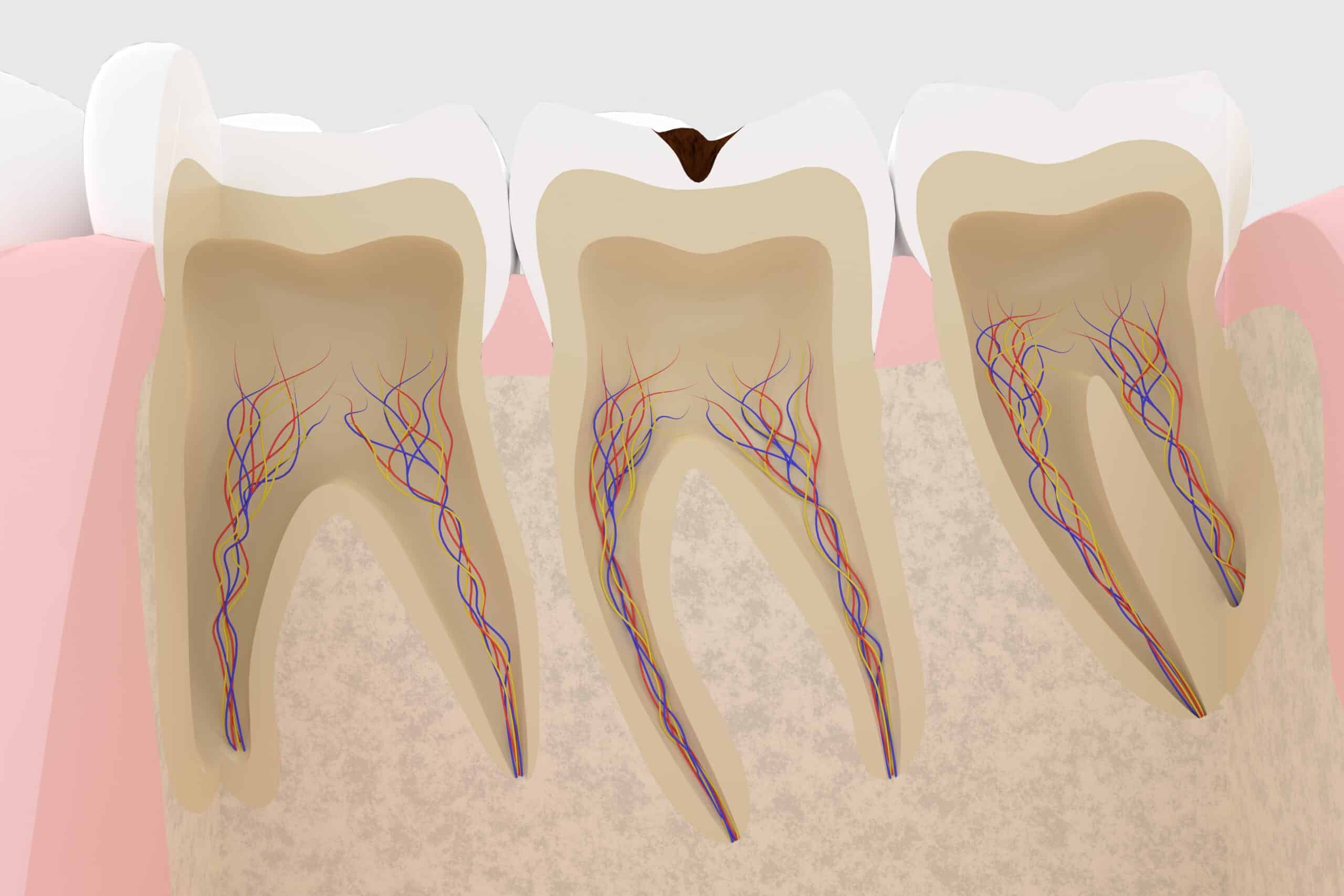 Cross-section of tooth roots showing infection