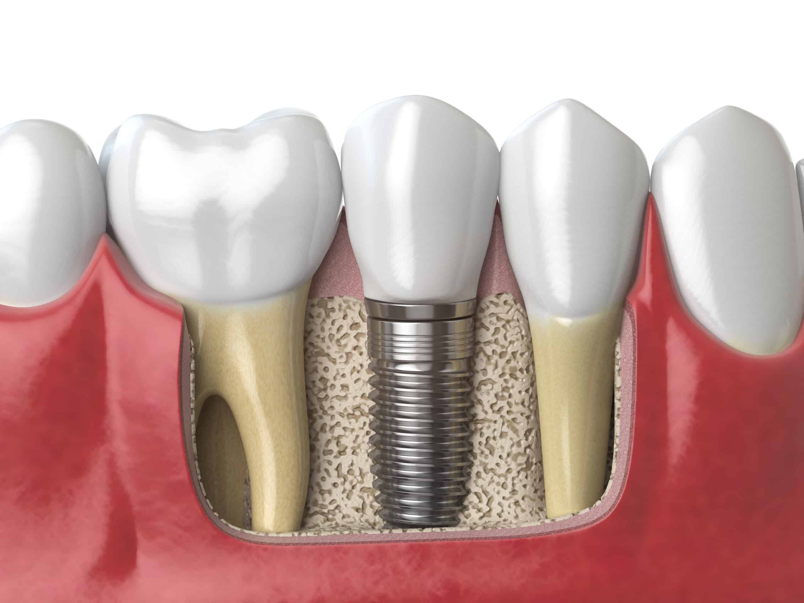 Cross-section illustration of dental implants and crowns