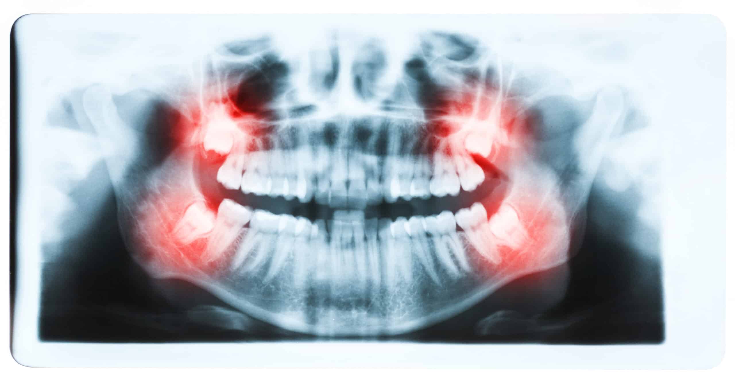 Dental X-ray highlighting impacted wisdom teeth